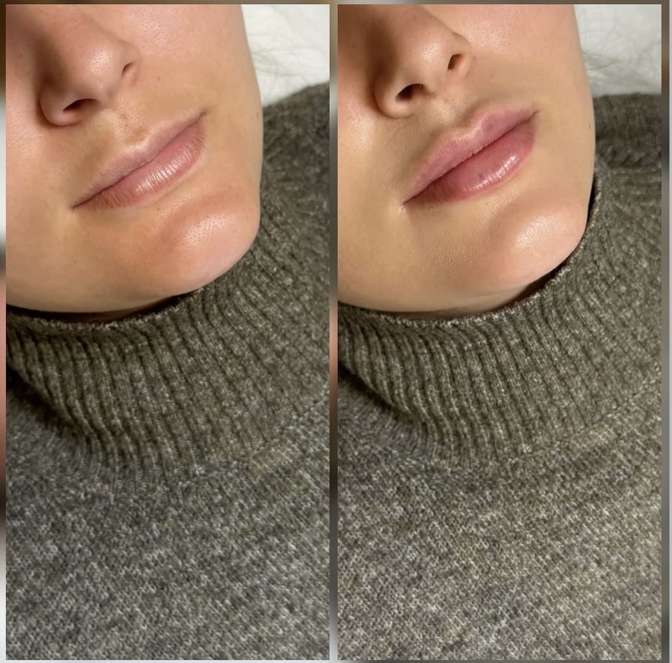 Fillers läppar västerås
