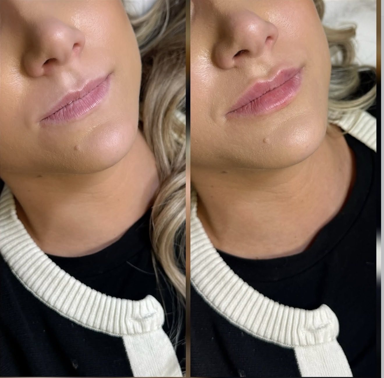 Fillers läppar västerås