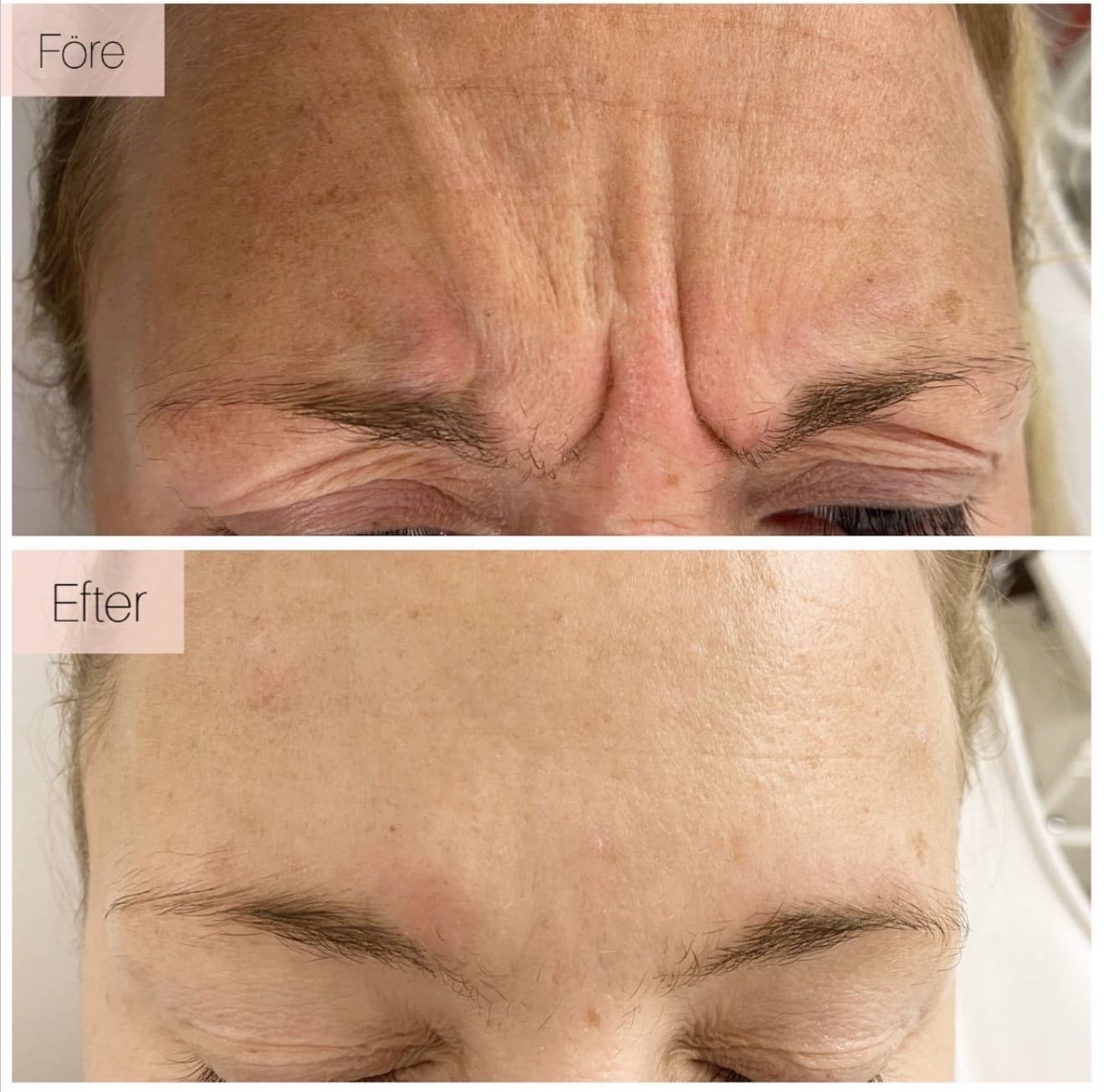 Botox 1 område