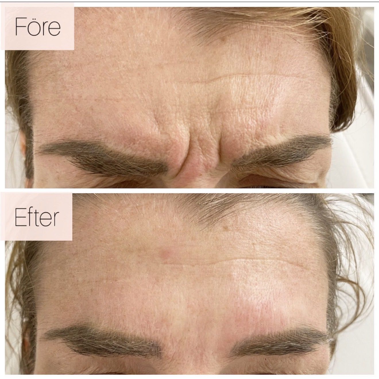 Botox glabella västerås