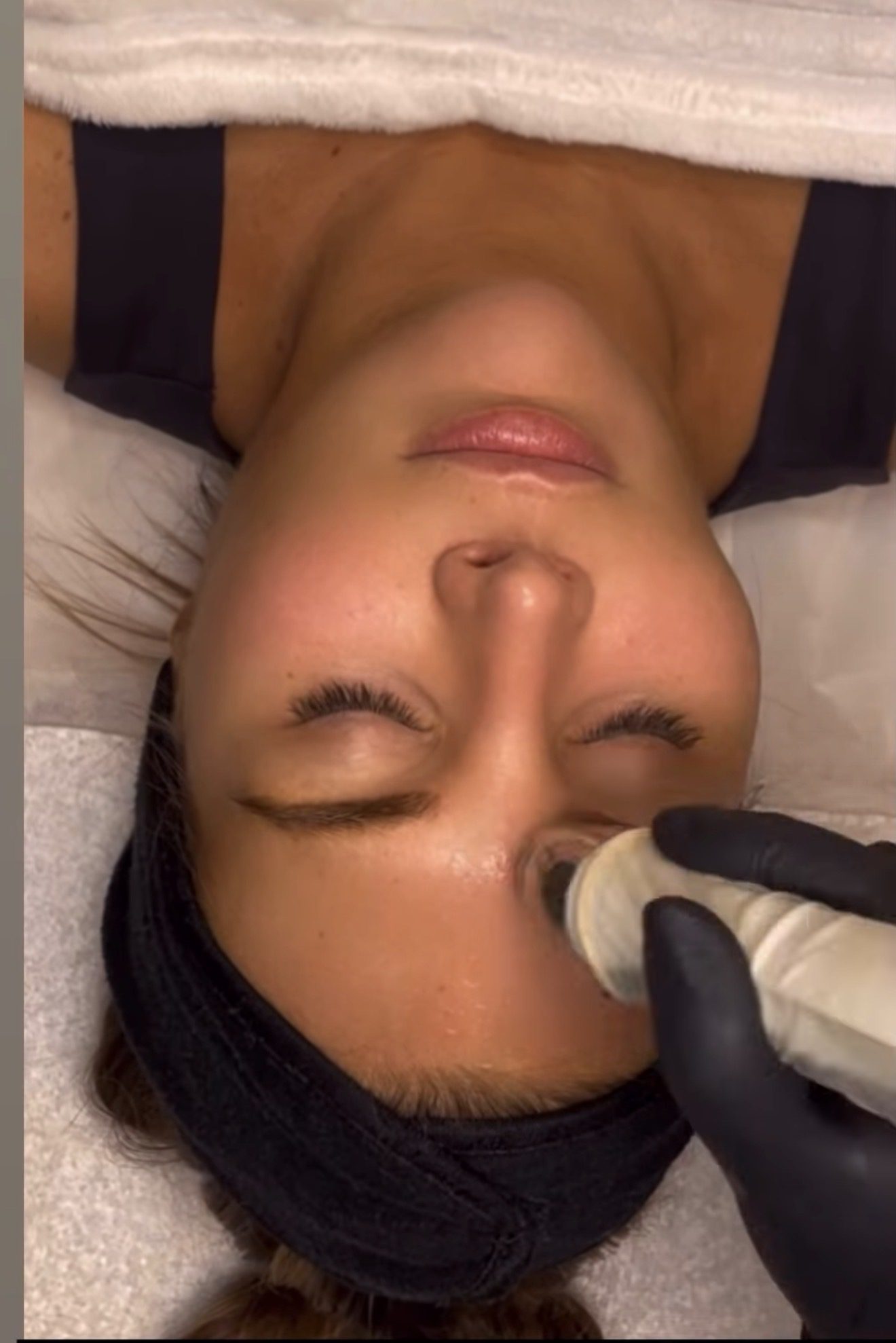 Microneedling Västerås