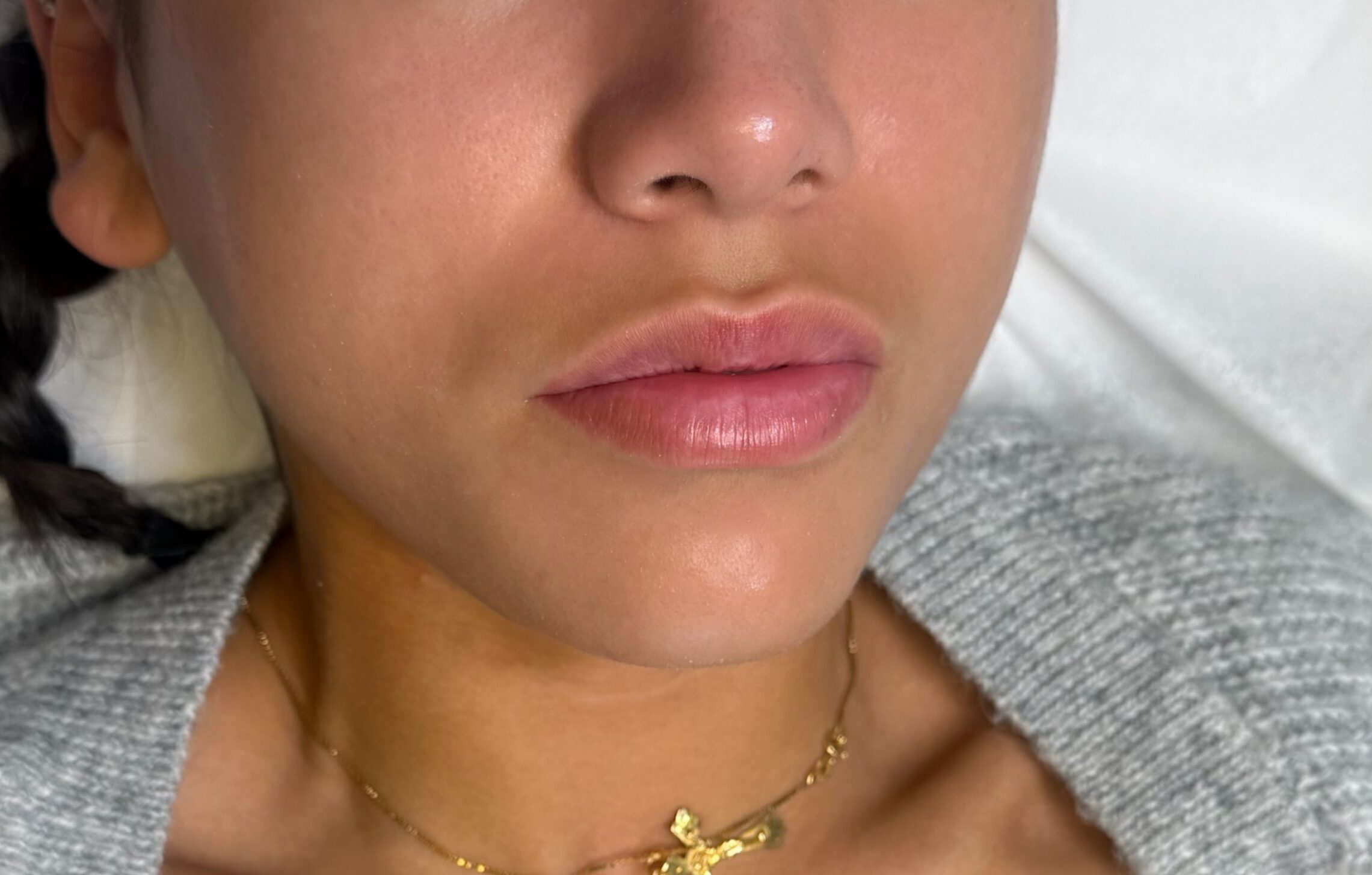Före fillers